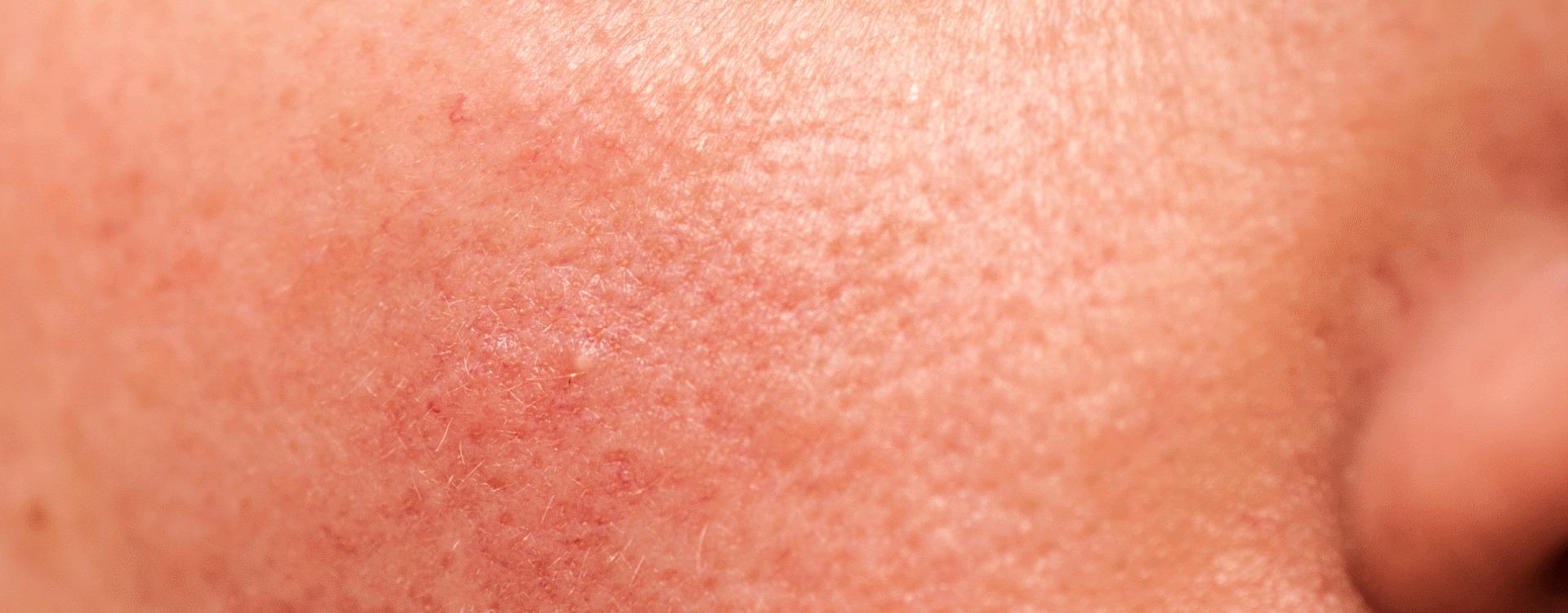 Rosácea - Tratamento Caseiro - Os Melhores Produtos para a tua Pele